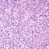 14D Oligodendroglioma, anaplastic (Case 14D) H&E 2