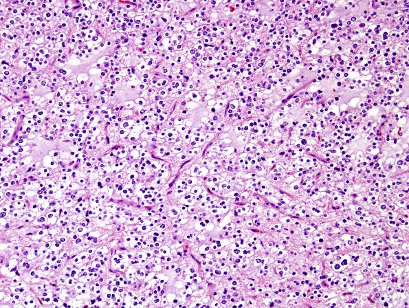 14D Oligodendroglioma, anaplastic (Case 14D) H&E 2