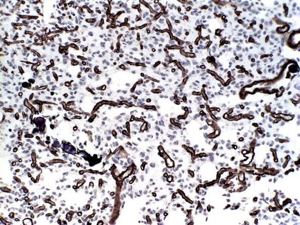 14E Oligodendroglioma, mild anaplasia (Case 14E) Coll IV