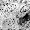 14F Oligodendroglioma (Case 14F) EM 1 - Copy