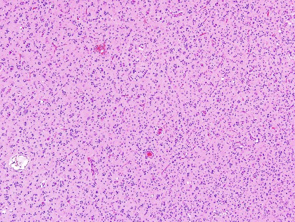 15A1 Oligodendroglioma, Grade 2 1p19q del (Case 15) H&E 3