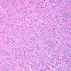 15A2 Oligodendroglioma, Grade 2 1p19q del (Case 15) H&E 8