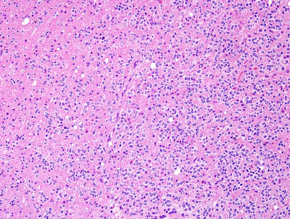 15A2 Oligodendroglioma, Grade 2 1p19q del (Case 15) H&E 8