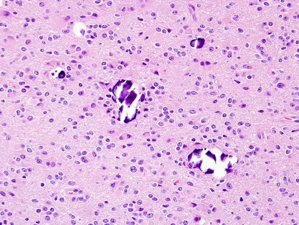 15A3 Oligodendroglioma, Grade 2 1p19q del (Case 15) H&E 6