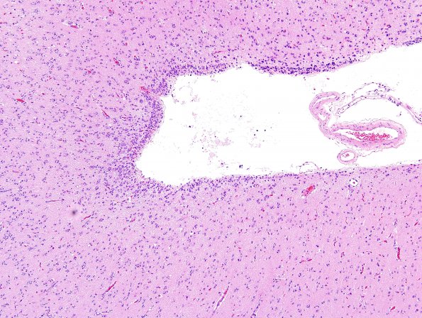 15A4 Oligodendroglioma, Grade 2 1p19q del (Case 15) H&E 10