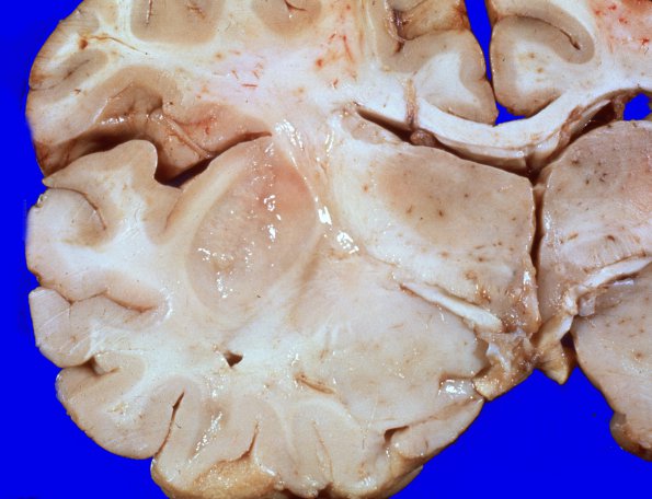 1A Oligodendroglioma (Case 1)