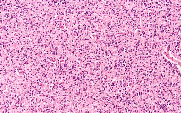 1B Oligodendroglioma (Case 1) H&E 20X