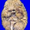 2A1 Oligodendroglioma, Grade 2 (Case 2) A5