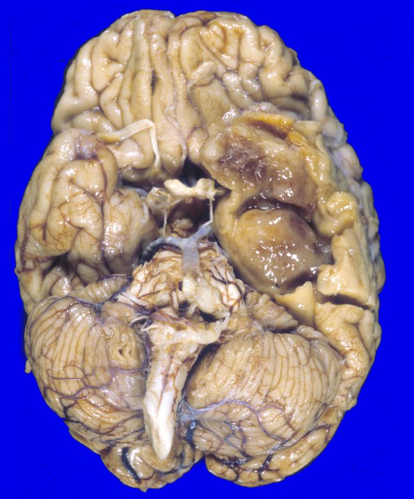 2A1 Oligodendroglioma, Grade 2 (Case 2) A5