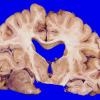 2A2 Oligodendroglioma, Grade 2 (Case 2) 1