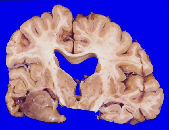 2A2 Oligodendroglioma, Grade 2 (Case 2) 1