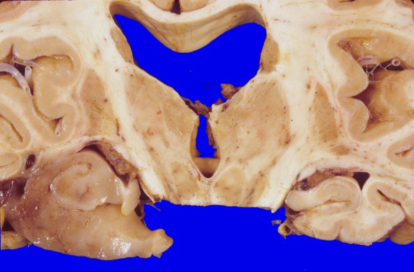 2A3 Oligodendroglioma, Grade 2 (Case 2) 4