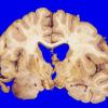 2A4 Oligodendroglioma, Grade 2 (Case 2) A3