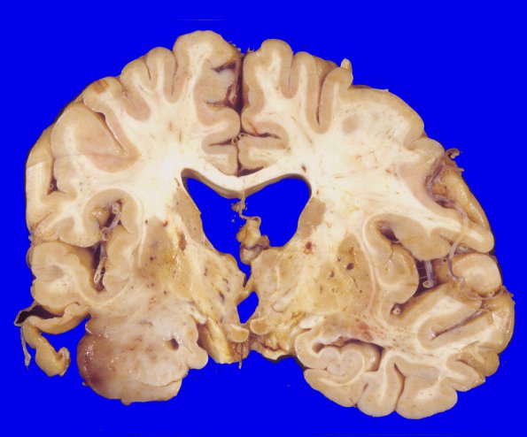 2A4 Oligodendroglioma, Grade 2 (Case 2) A3