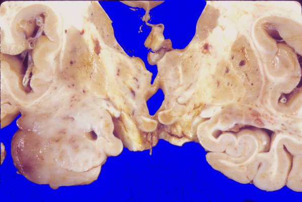 2A5 Oligodendroglioma, Grade 2 (Case 2) A2