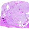 2B1 Oligodendroglioma, Grade 2 (Case 2) N13 H&E