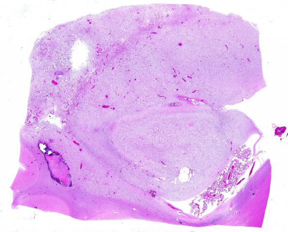 2B1 Oligodendroglioma, Grade 2 (Case 2) N13 H&E