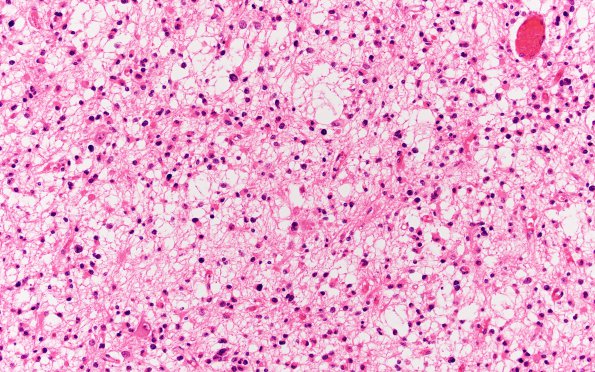 2B2 Oligodendroglioma, Grade 2 (Case 2) N13 H&E 20X