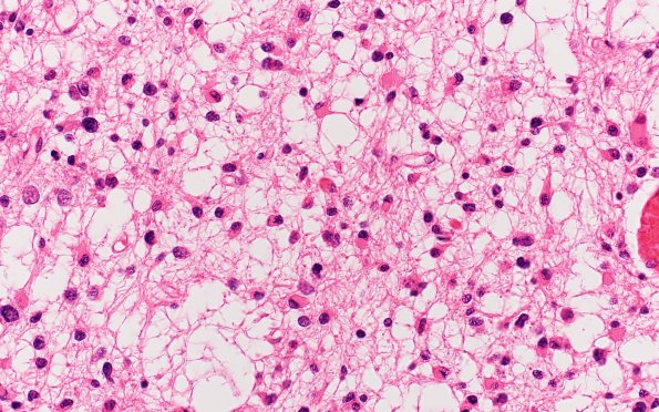 2B3 Oligodendroglioma, Grade 2 (Case 2) N13 H&E 40X