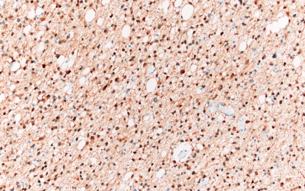 2C2 Oligodendroglioma, Grade 2 (Case 2) IDH1 20X