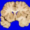 3A1 Oligodendroglioma, Grade 2 (Case 3) 1