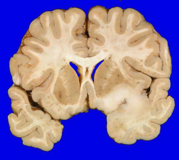 3A1 Oligodendroglioma, Grade 2 (Case 3) 1