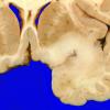 3A2 Oligodendroglioma, Grade 2 (Case 3)  2