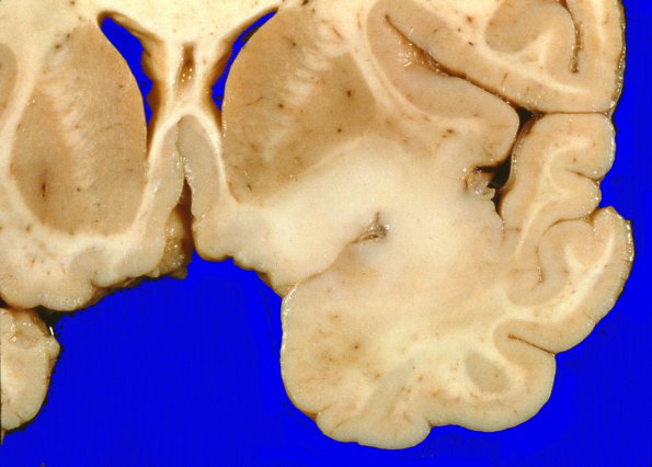 3A2 Oligodendroglioma, Grade 2 (Case 3)  2