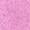 3B Oligodendroglioma (Case 3)  H&E N16 20X 1