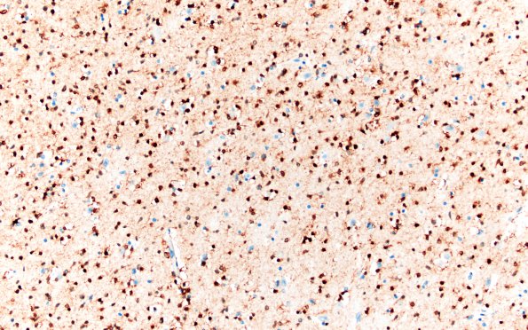 3C Oligodendroglioma, Grade 2 (Case 3)  IDH 20X