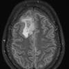 4A1 Oligodendroglioma, Grade 2, del 1p19q (Case 4) FLAIR - Copy