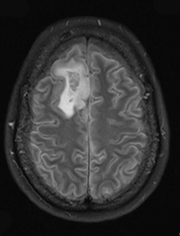 4A1 Oligodendroglioma, Grade 2, del 1p19q (Case 4) FLAIR - Copy