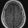 4A2 Oligodendroglioma, Grade 2, del 1p19q (Case 4) T1 - Copy