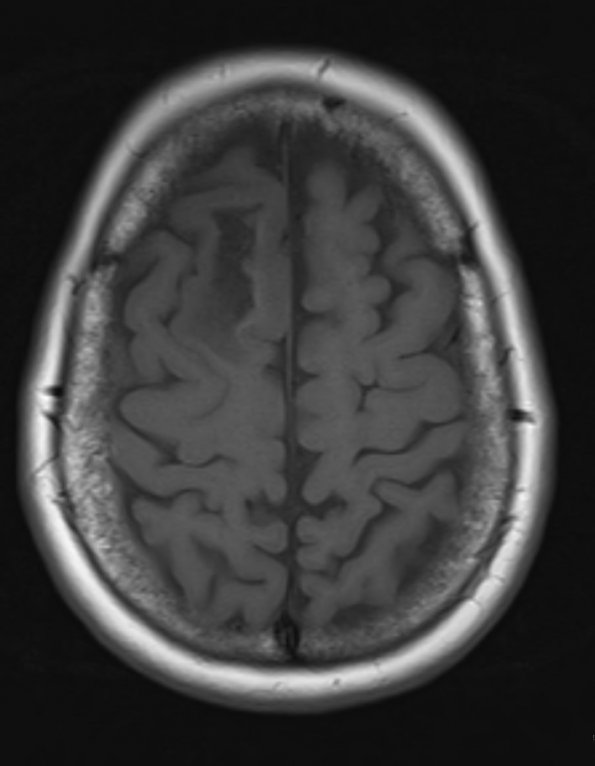 4A2 Oligodendroglioma, Grade 2, del 1p19q (Case 4) T1 - Copy