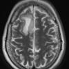 4A3 Oligodendroglioma, Grade 2, del 1p19q (Case 4) T2 W 1 - Copy