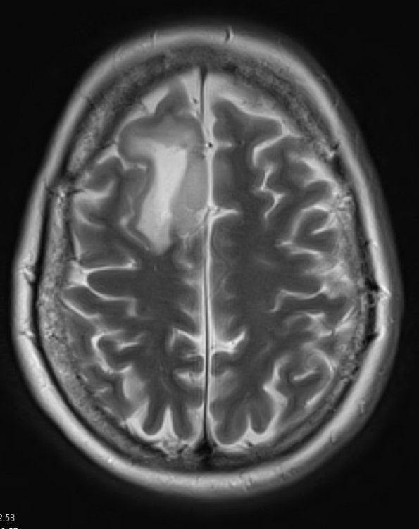 4A3 Oligodendroglioma, Grade 2, del 1p19q (Case 4) T2 W 1 - Copy