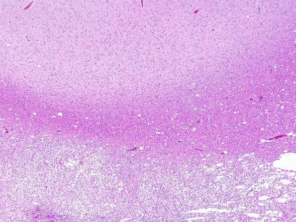 4B1 Oligodendroglioma, Grade 2, del 1p19q (Case 4) H&E 13