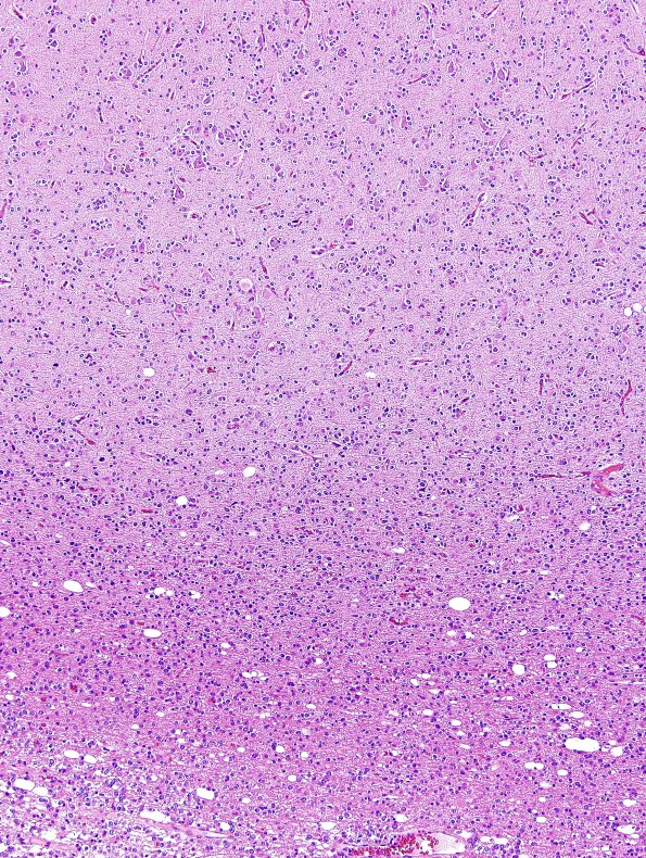 4B2 Oligodendroglioma, Grade 2, del 1p19q (Case 4) H&E 14