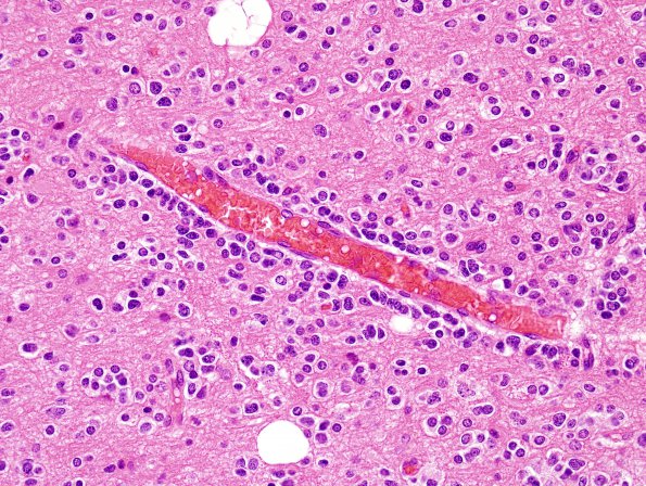 4B3 Oligodendroglioma, Grade 2, del 1p19q (Case 4) H&E 1
