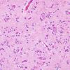 4B4 Oligodendroglioma, Grade 2, del 1p19q (Case 4) H&E 12