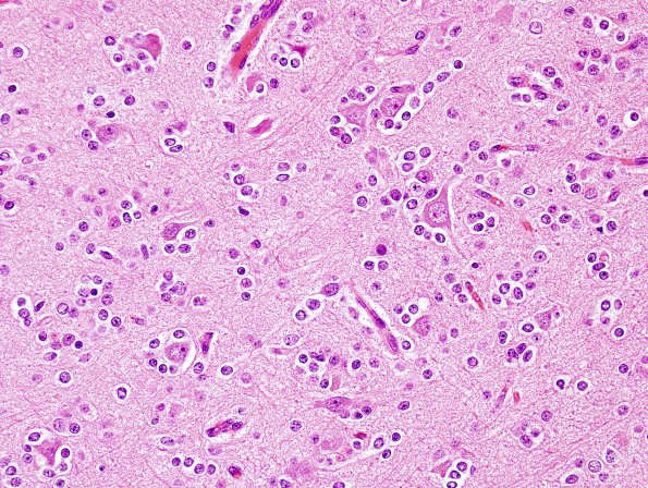 4B4 Oligodendroglioma, Grade 2, del 1p19q (Case 4) H&E 12