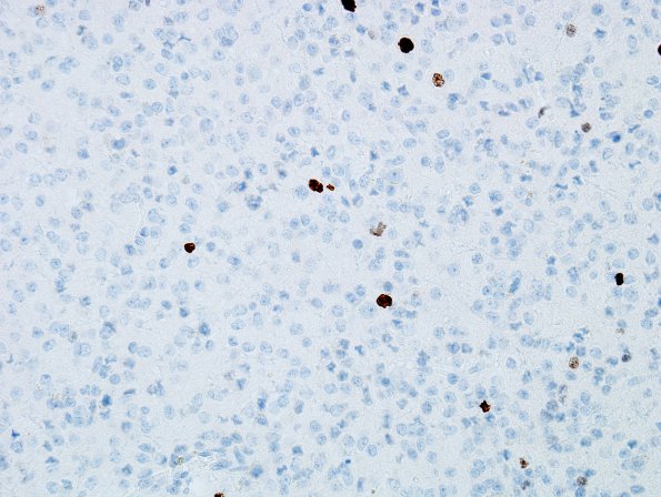 4C Oligodendroglioma, Grade 2, del 1p19q (Case 4) MIB 2