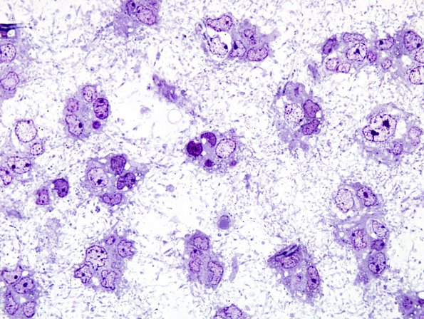 5A1 Oligodendroglioma (Case 5) Plastic 9