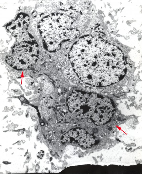 5B Oligodendroglioma (Case 5) 9000X EM 1 copy - Copy