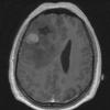 6A1 Oligodendroglioma, anaplastic, Grade 3 (Case 6) T1W 2 - Copy