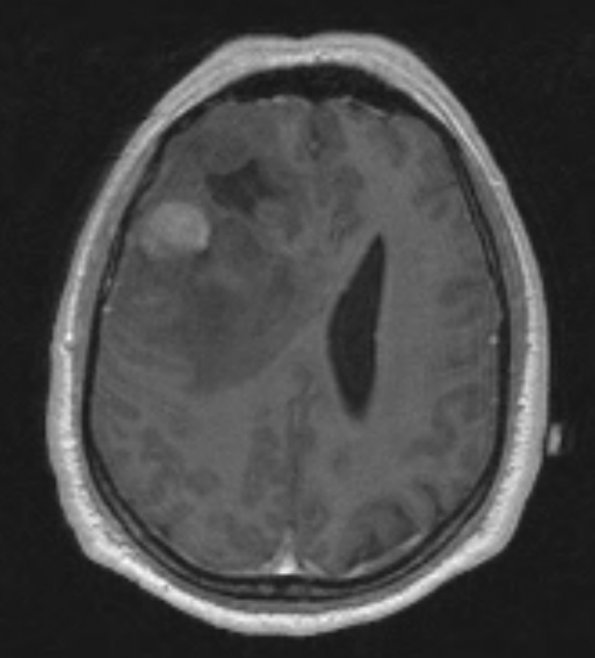 6A1 Oligodendroglioma, anaplastic, Grade 3 (Case 6) T1W 2 - Copy