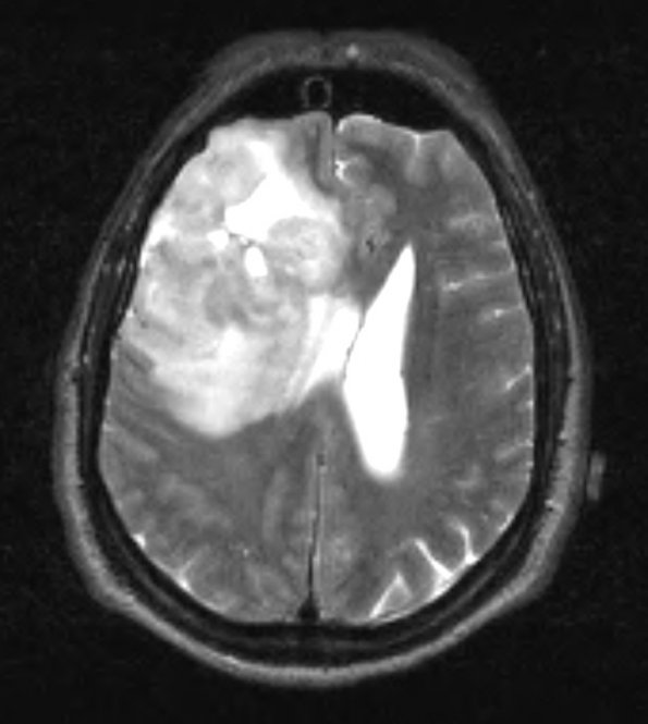 6A2 Oligodendroglioma, anaplastic, Grade 3 (Case 6) T2 2 - Copy