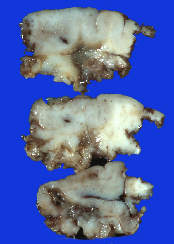 6B Oligodendroglioma, grade 3 (Case 6) 1