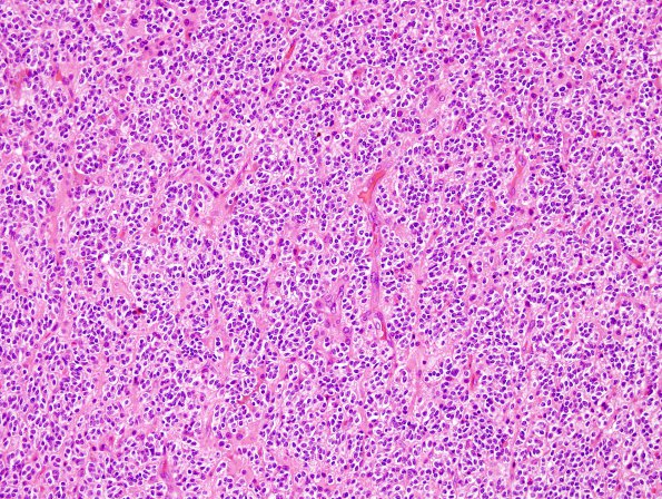 6C2 Oligodendroglioma, anaplastic (Case 6) H&E 13