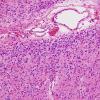 6C3 Oligodendroglioma, anaplastic (Case 6) H&E 11